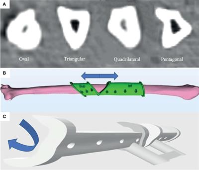 A Comparative Study on a Novel Fibula Malleolus Cap to Increase the Accuracy of Oncologic Jaw Reconstruction